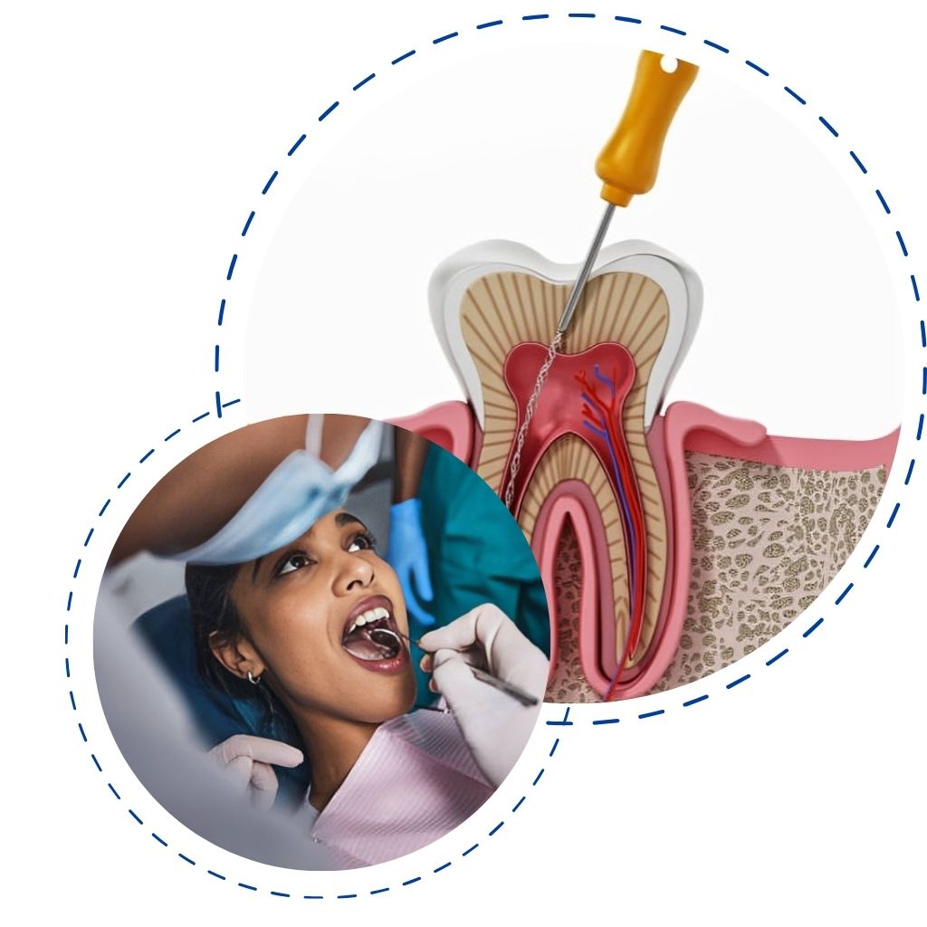 best root canal treatment in HSR layout