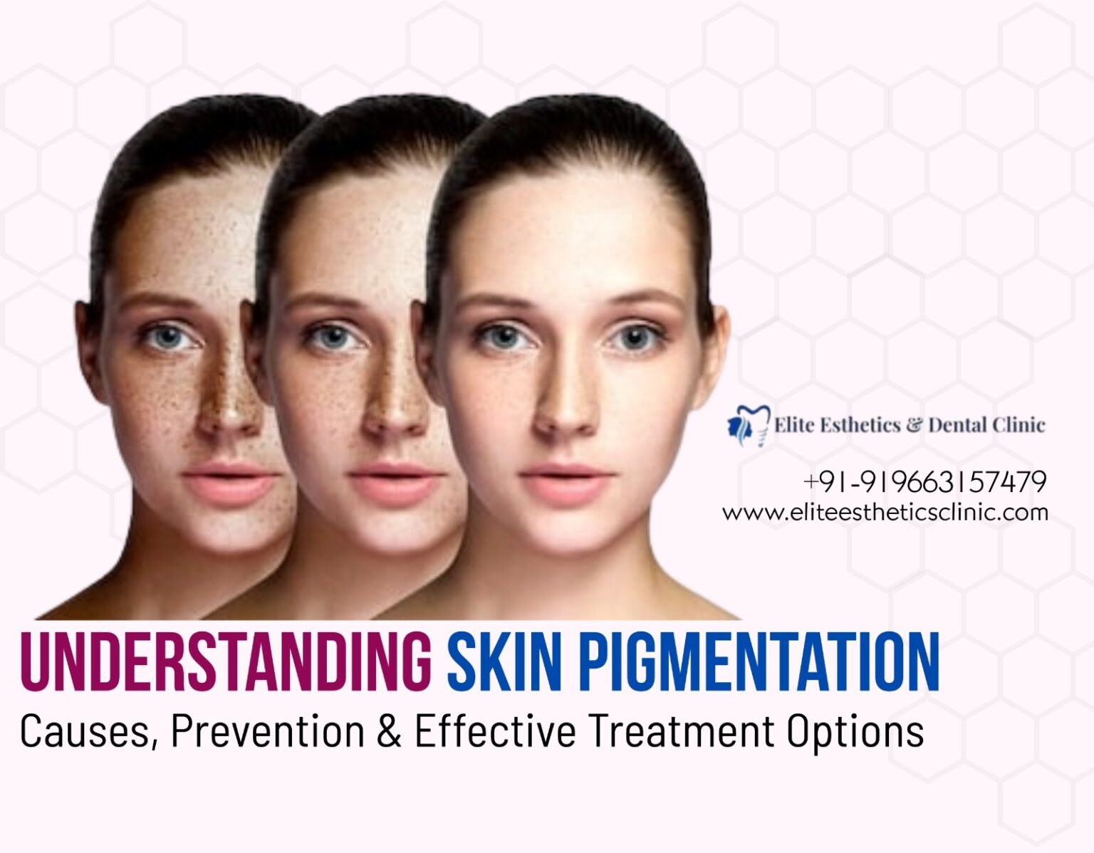 Understanding Skin Pigmentation: Causes, Prevention & Effective ...
