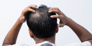 A middle aged Indian man showing his hair fall back facing on white background