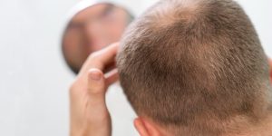 Scarring Alopecia